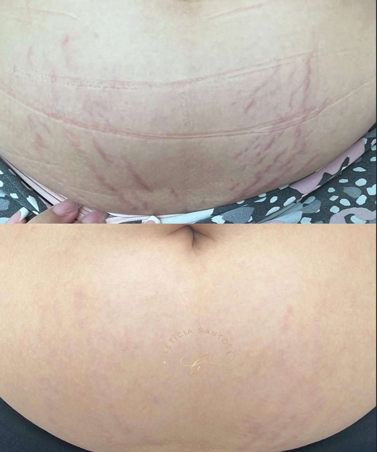 Gestação — estrias vermelhas