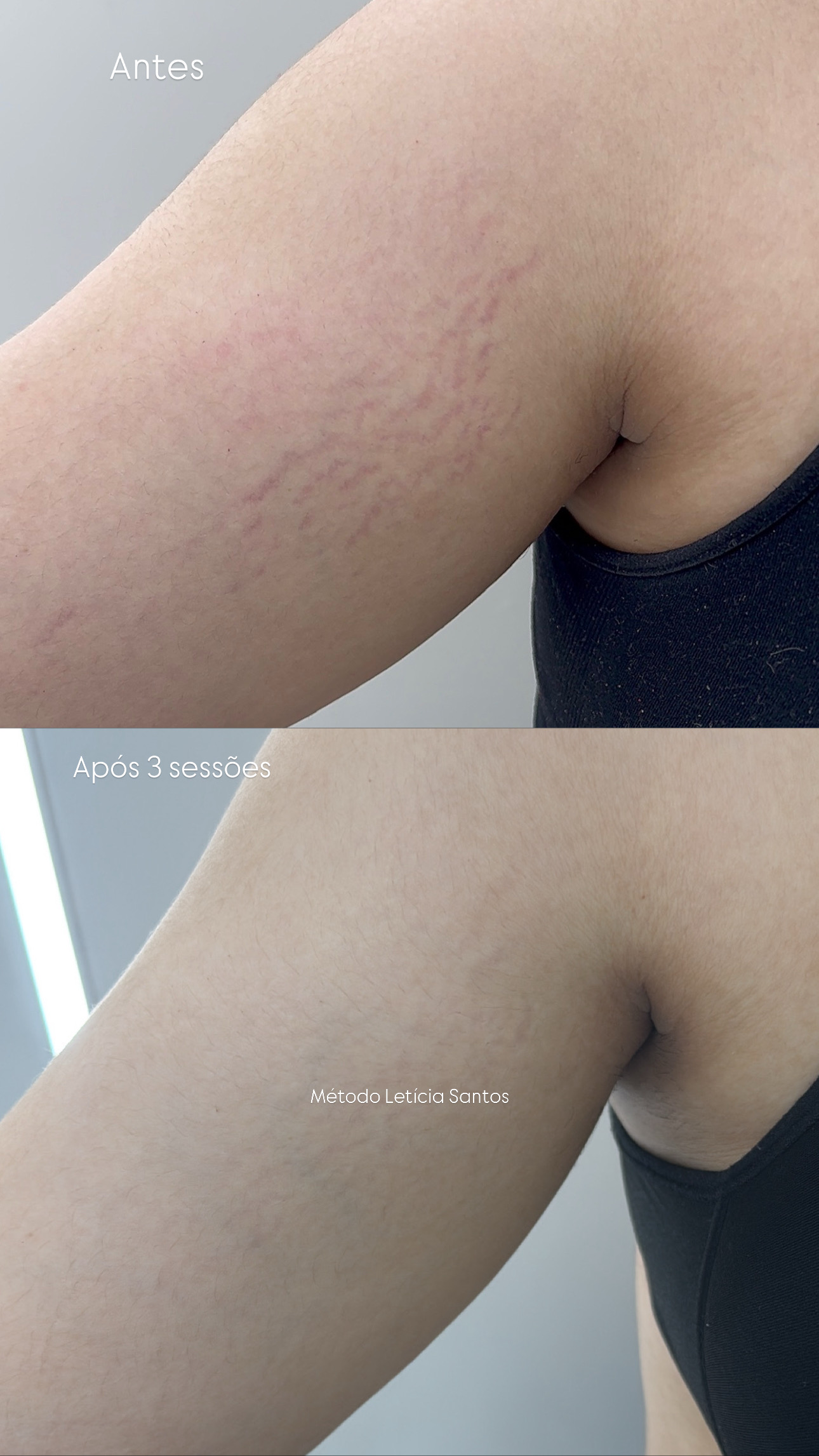 Braços — antes e depois