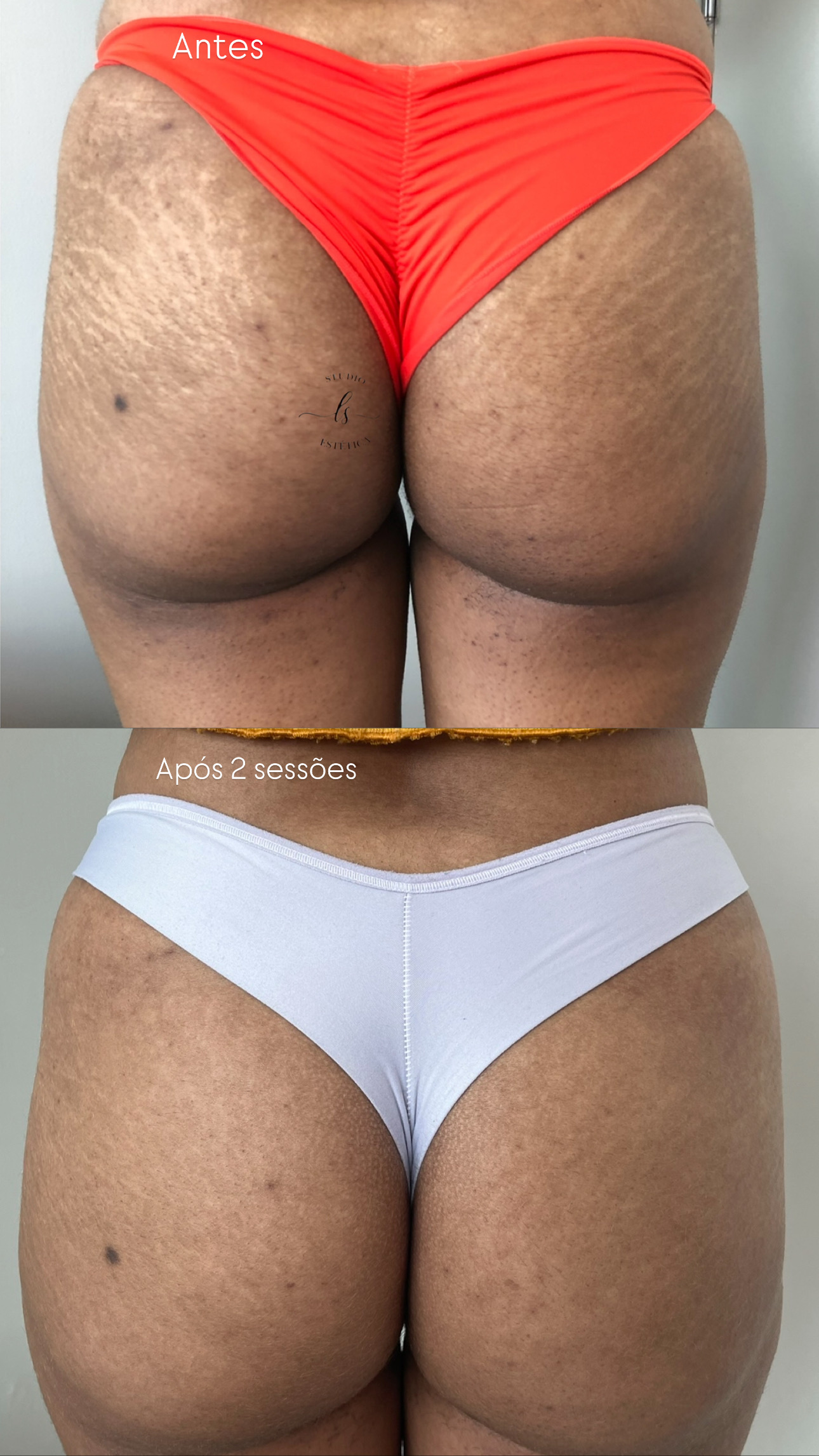 Glúteos — antes e depois