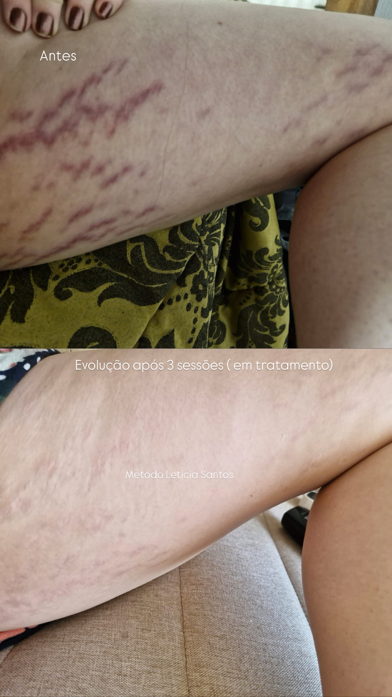 Coxas — em tratamento