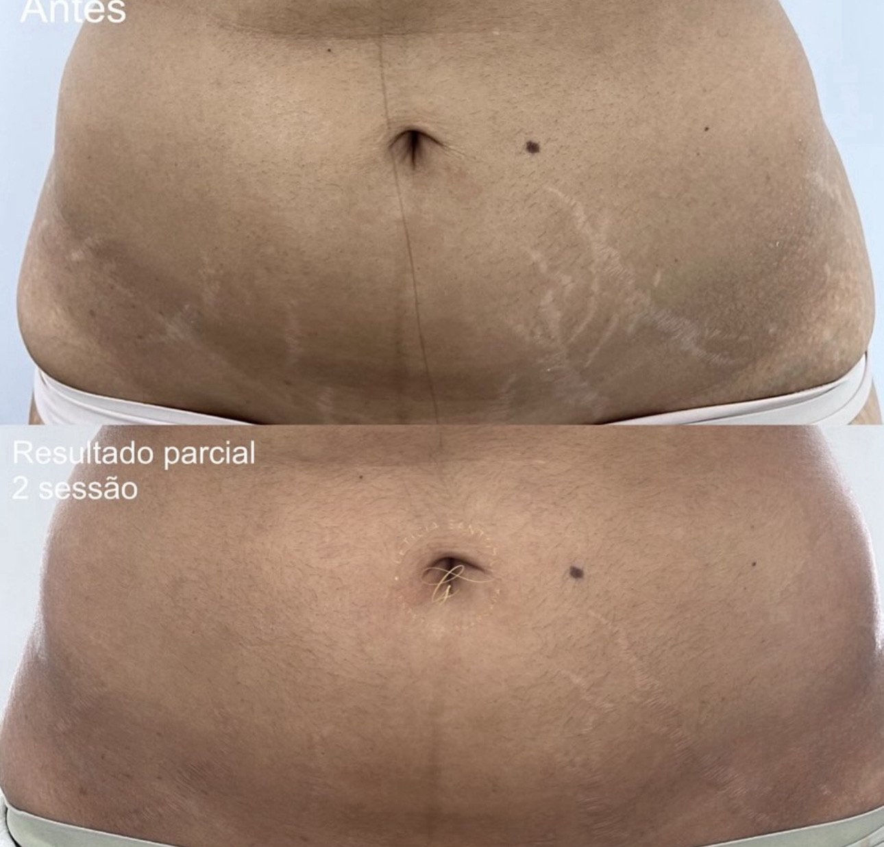 Gestação — estrias brancas