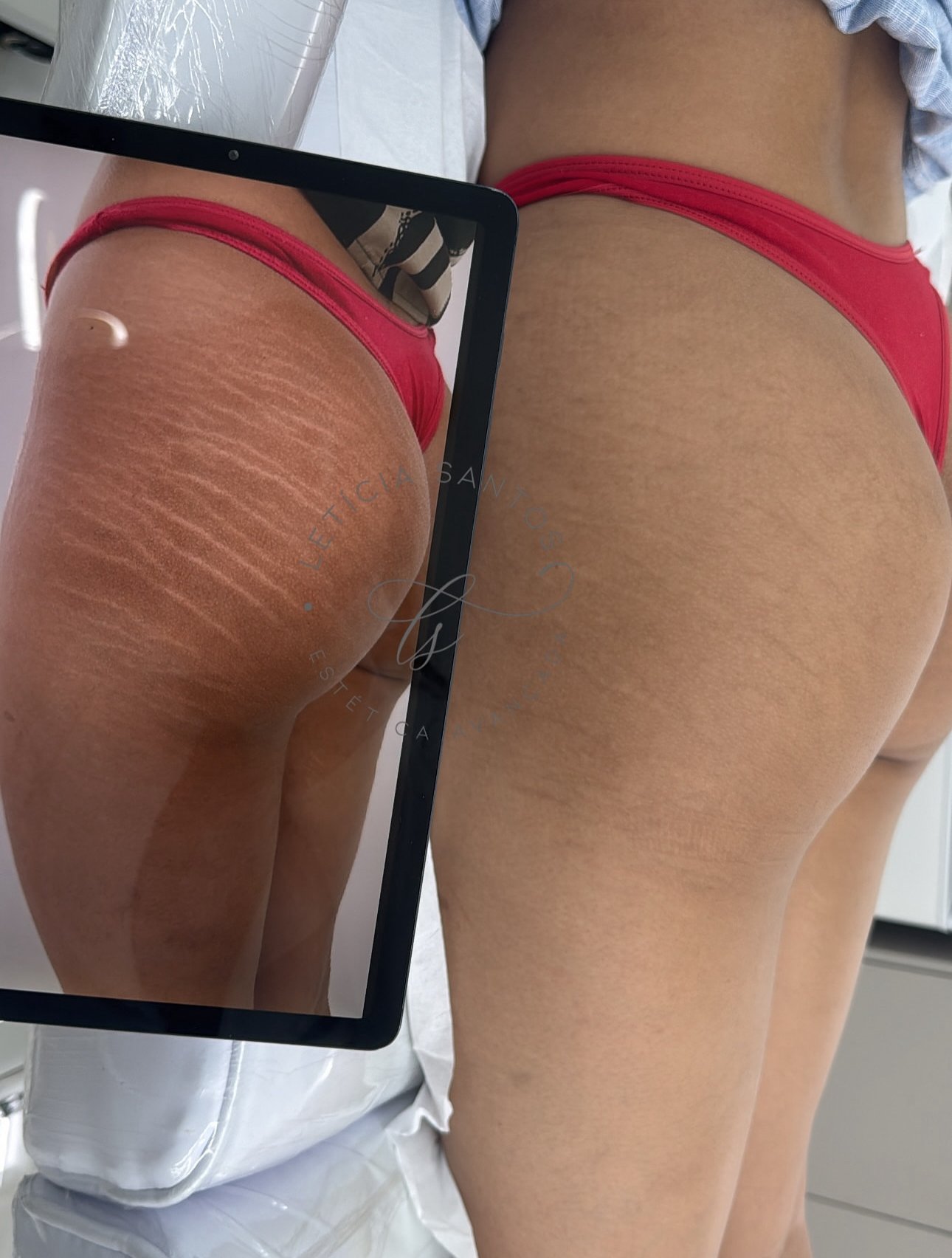 Pernas e glúteos — resultado